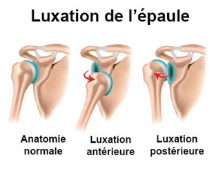 luxationepaule